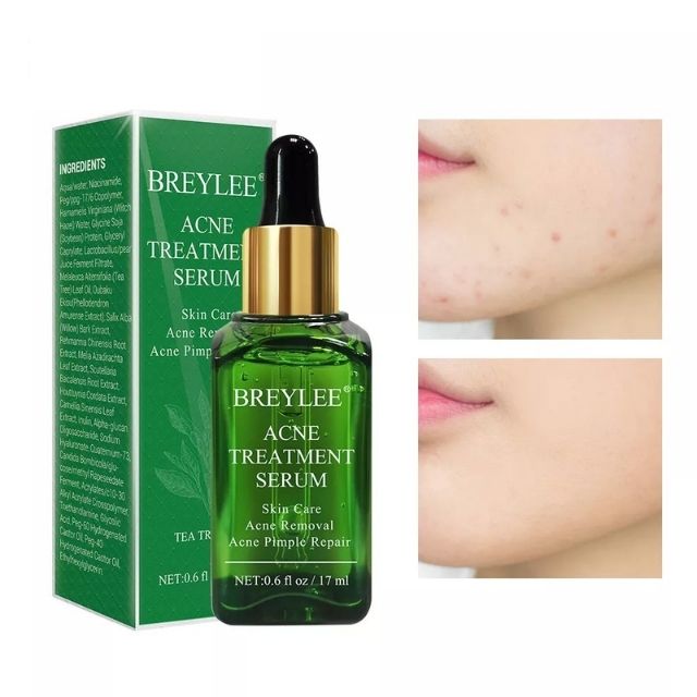 Soro Removedor de Acne - Imagem 4